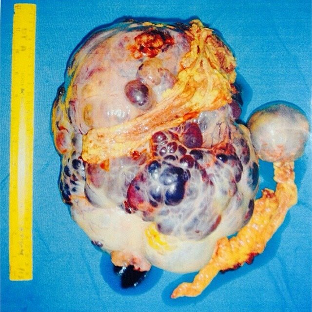 手術後取出嘅腫瘤，足足有4.8kg重。