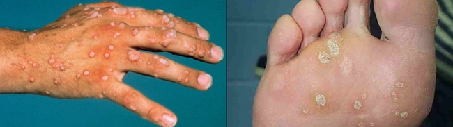 疣嘅病毒一發作，通常會喺手腳生瘡。